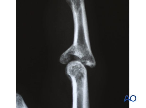 Lateral x-ray showing central impaction fracture of middle phalangeal base.