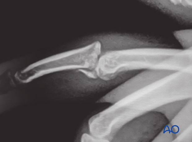 Lateral x-ray showing palmar multifragmentary impaction fracture of middle phalangeal base with dorsal dislocation.