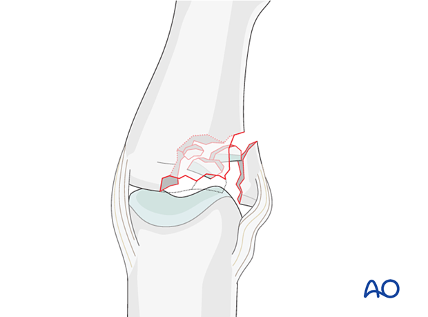 Illustration showing multifragmentary articular fracture of middle phalangeal base with dorsal or dorsal rotatory instability due to lateral angulation and axial loading, leading to impaction fracture.