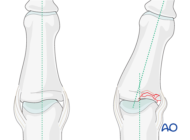 Illustration showing multifragmentary articular fracture of middle phalangeal base with coronal plane malalignment indicating impaction.