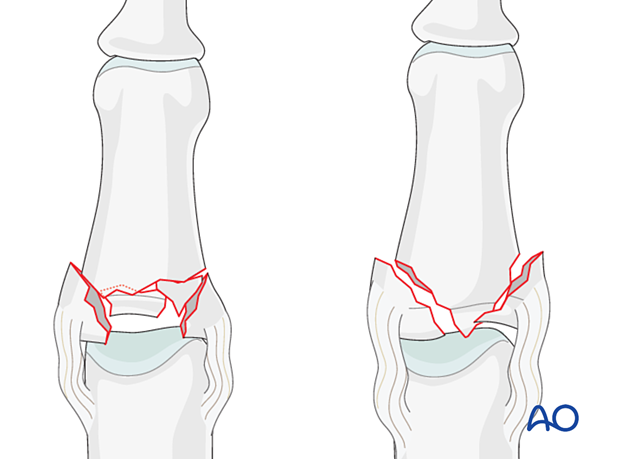 Illustration showing multifragmentary articular fracture of middle phalangeal base in two configurations: centrally impacted, comminuted fractures, and T- or Y-type fracture geometry. Impaction injuries can lead to PIP joint fracture dislocation, joint stiffness, and osteoarthritis.