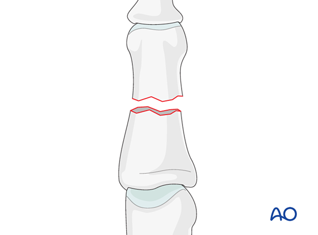 Illustration of transverse extraarticular and diaphyseal fractures of the middle phalanx, AO/OTA 78.2–5.2.1A, 2A, 3A.