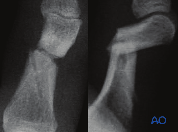 Illustration of transverse extraarticular and diaphyseal fractures of the middle phalanx, AP and lateral x-rays show dorsal tilt of distal fragment and additional oblique fracture in diaphysis.