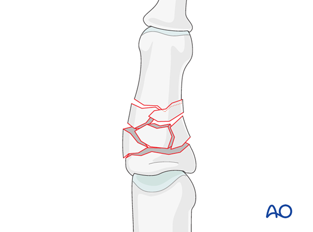 Illustration of multifragmentary extraarticular and diaphyseal fracture of the middle phalanx, AO/OTA 78.2–5.2.1A, 2B, 2C, 3A.