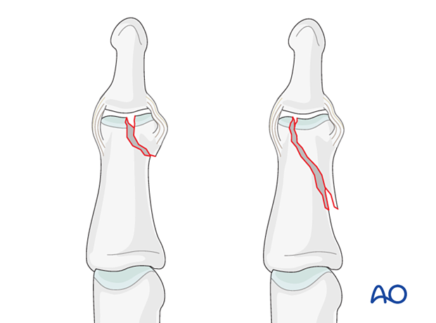 Illustration of partial articular fracture of the middle phalangeal head, unicondylar fractures can be oblique or comminuted.