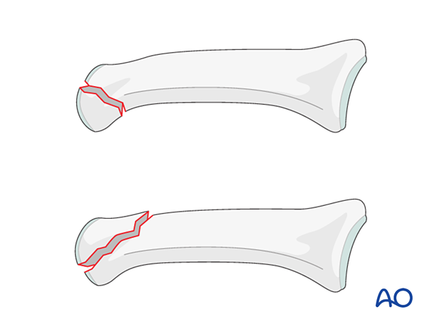 Illustration of partial articular fracture of the middle phalangeal head, coronal fractures are rare and often linked to DIP joint dislocation.