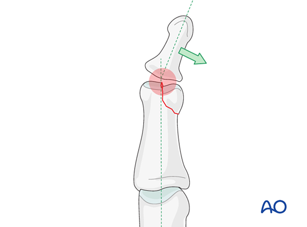 Illustration of partial articular fracture of the middle phalangeal head, minimal unicondylar depression may cause finger angulation.