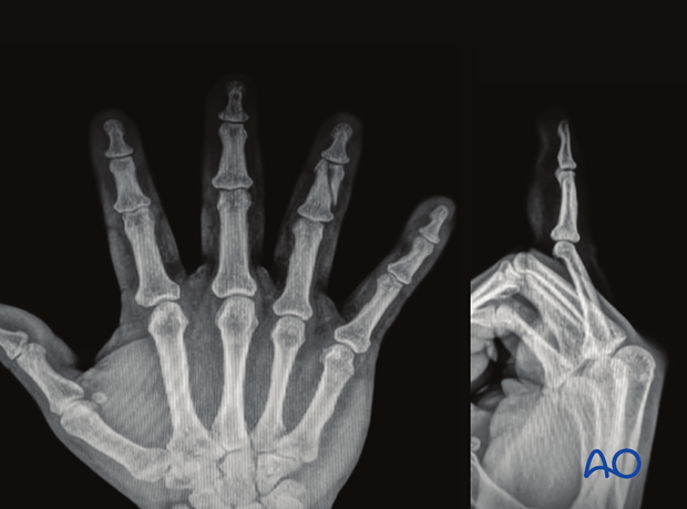 Illustration of partial articular fracture of the middle phalangeal head, AP and lateral x-rays show a long fracture of the 4th middle phalangeal head.