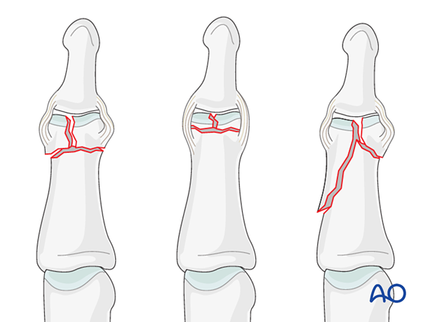 Illustration of complete articular fracture of the middle phalangeal head, classified as 78.2–5.2.3C.