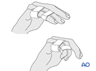 Buddy strapping of a collateral ligament avulsion of the middle phalangeal base