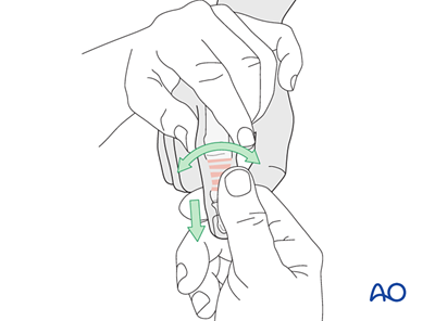 K-wire fixation for Transverse extraarticular or diaphyseal fracture