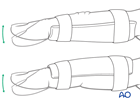 Finger splintage of a dorsal avulsion of the middle phalangeal base