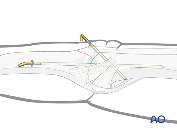 Extensor block pinning stabilizes displaced dorsal fragment, PIP joint transfixed with axial K-wire.