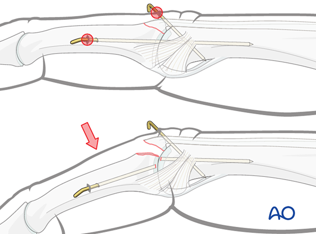 Percutaneous K-wire immobilization risk: infection; breakage avoided with thicker wire and splint