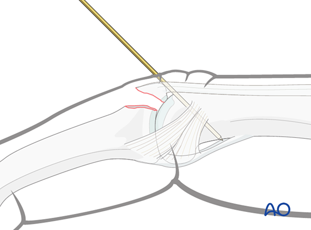 Extension block: 1.4 mm K-wire inserted at 45° through central band into proximal phalanx head