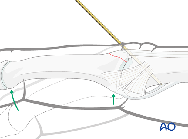 Fracture reduction: extend PIP joint, adjust distal fragment, confirm with lateral view image intensifier