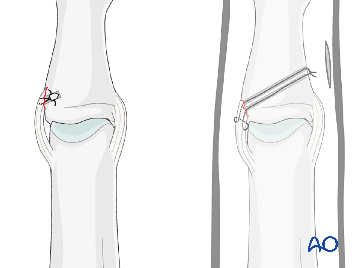 Collateral Ligament Repair For Dislocation Of The Proximal Collateral Ligament Repair For Dislocation Of The Proximal