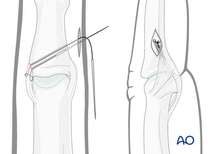 Transfixation Incision Collateral ligament repair for Dislocation of the proximal ...