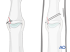 Collateral ligament reattachment of a collateral ligament avulsion of the middle phalangeal base