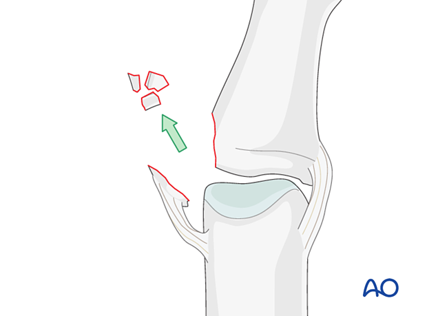 Remove free fragments to prevent joint obstruction, while maintaining fragments attached to the ligament.