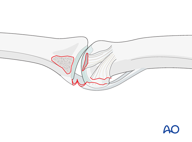 Collateral ligament completely detached from the middle phalanx and volar plate in this injury.