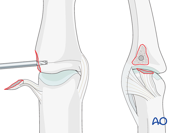 Extend the finger for better visualization, prepare a pilot hole for the anchor, and consider two minianchors for fragment fixation.