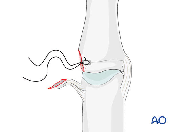 Insert the anchor at the isometric point, ensuring it is fully buried in the bone per manufacturer’s instructions.