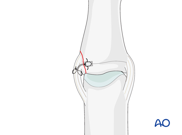 Approximate the collateral ligament and volar plate, insert and knot the suture from the proximal to the distal end.