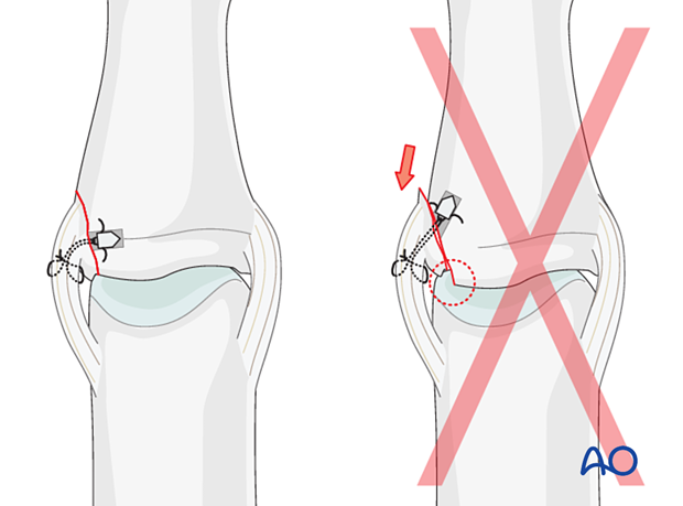 Avoid nonanatomic ligament repair to prevent articular damage, instability, stiffness, arthritis, and secondary fracture displacement.