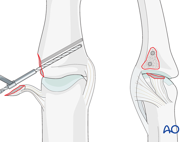 Create two parallel drill holes using a 1.0 mm drill or K-wire, angled from proximal to distal, with soft-tissue protection using a drill sleeve.