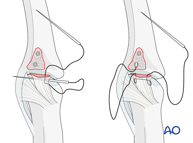 Pass 4.0 sutures through drill holes, create locking loops, and use an 18-gauge needle for guidance.