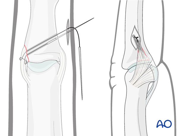 Create an incision, tension sutures to approximate the ligament, and secure over the cortical bone bridge.