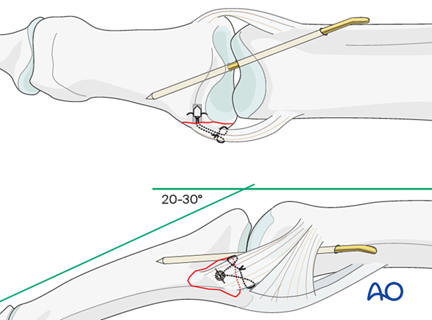 Pass a 1.2 mm K-wire across the PIP joint in 20°–30° flexion, protect with a splint, and leave the wire end outside the skin for later removal.
