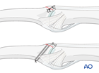 Central slip reattachment of a dorsal avulsion of the middle phalangeal base