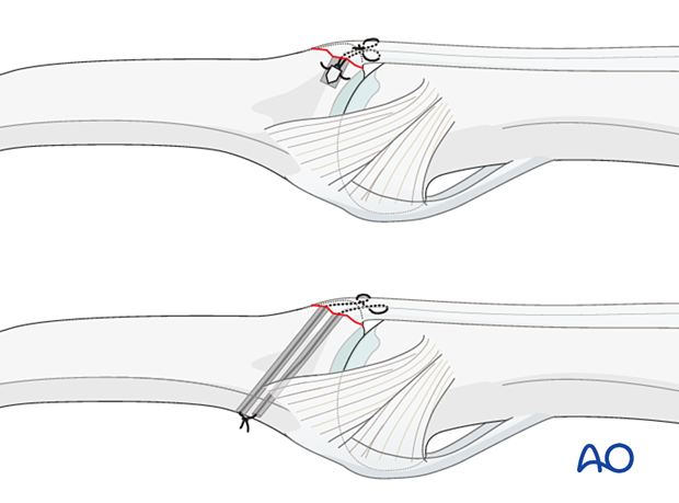 Two techniques for central slip reattachment: suture anchors and tunneling