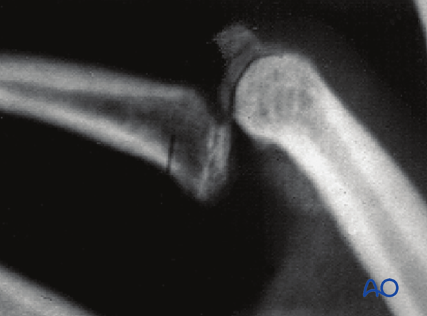 Dorsal avulsion of the middle phalanx, lateral x-ray shows dorsal avulsion fracture with palmar dislocation.