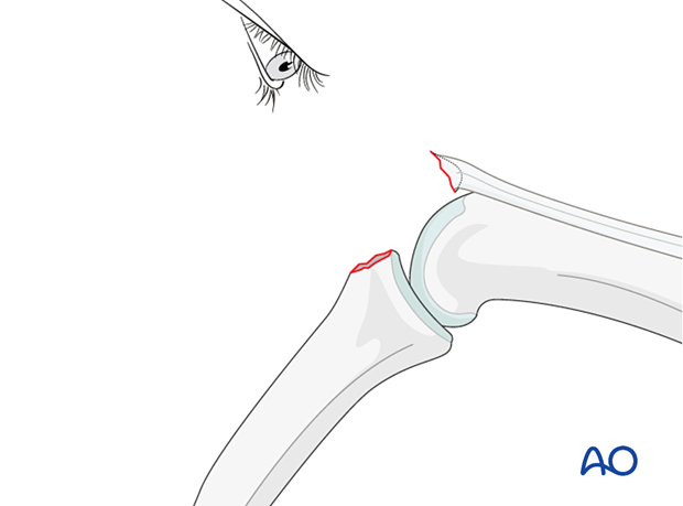 Flex PIP joint for better fracture view; use dental pick to clear interposed tissues