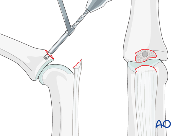 Keep PIP flexed to visualize fracture; use drill to prepare pilot hole for anchor