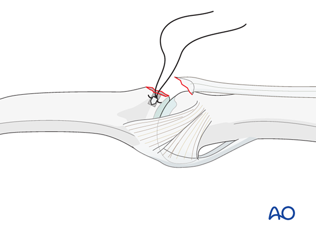 Insert anchor at isometric point, ensuring it's fully buried in the bone as per instructions