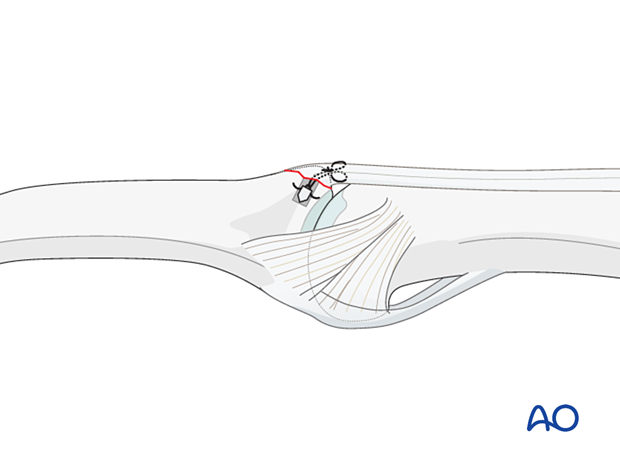 Insert sutures into ligament, reapproximate central slip, and tie knot to secure tendon