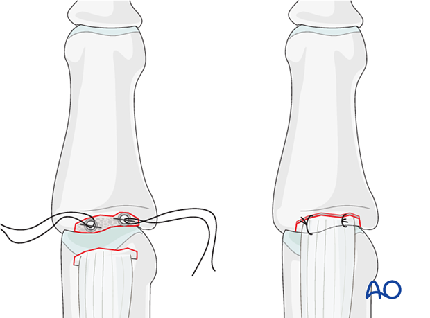 Central slip reattachment with two suture anchors corresponding to fracture breadth