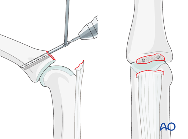 Central slip reattachment with two parallel drill holes angled from proximal to distal