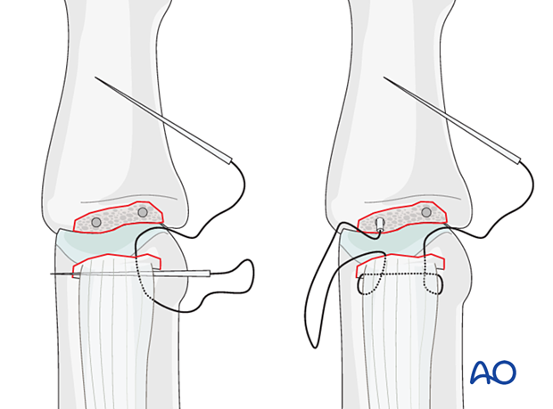 Central slip reattachment with 4.0 nonresorbable sutures threaded obliquely through drill holes