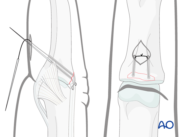 Central slip reattachment with sutures retrieved, needles cut off, and knot tied over cortical bone