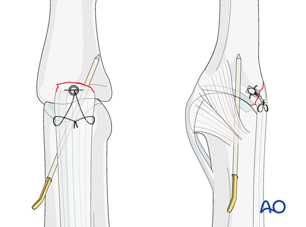 Central slip reattachment with 1.2 mm K-wire across PIP joint in extension, protected by splint