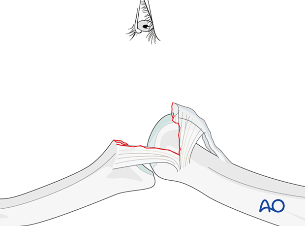 Hyperextend middle phalanx for maximal joint view, assess fracture geometry, comminution, and impaction.