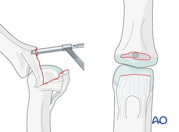 Keep PIP hyperextended to visualize fracture at phalanx base, prepare pilot hole with appropriate drill.