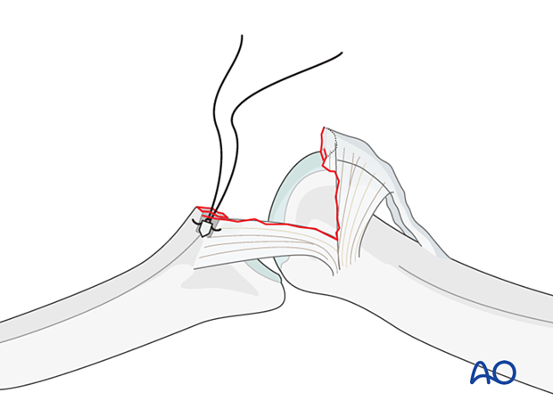 Insert appropriately sized anchor at isometric point per manufacturer’s instructions, fully bury in bone.