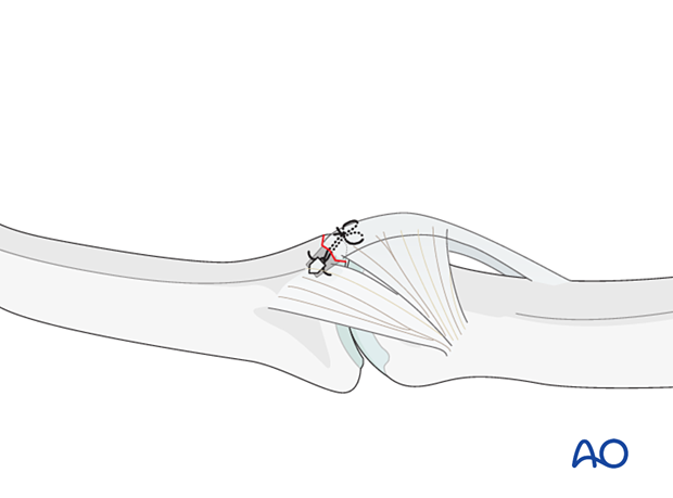 Insert sutures into free end of volar plate, loop and tie to secure to phalanx, ensuring smooth mobility.