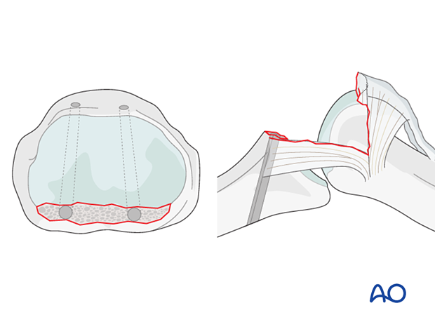 Choose drill hole diameter corresponding to width of small, avulsed fragment.